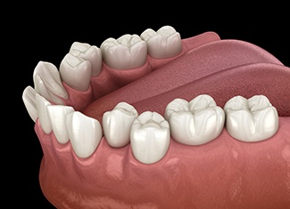 Illustration of crooked teeth