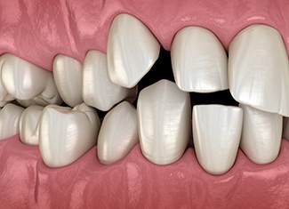 Illustration of spaced out teeth