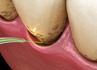 Illustration of gum disease treatment